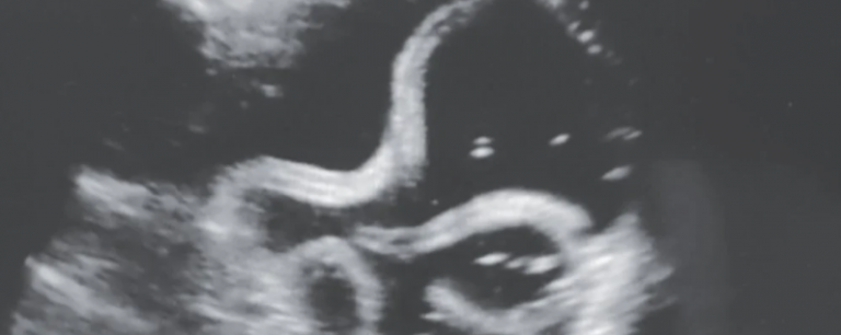 Nightmare Ultrasound Reveals Parasitic Worms Squirming Around Inside Man's Stomach